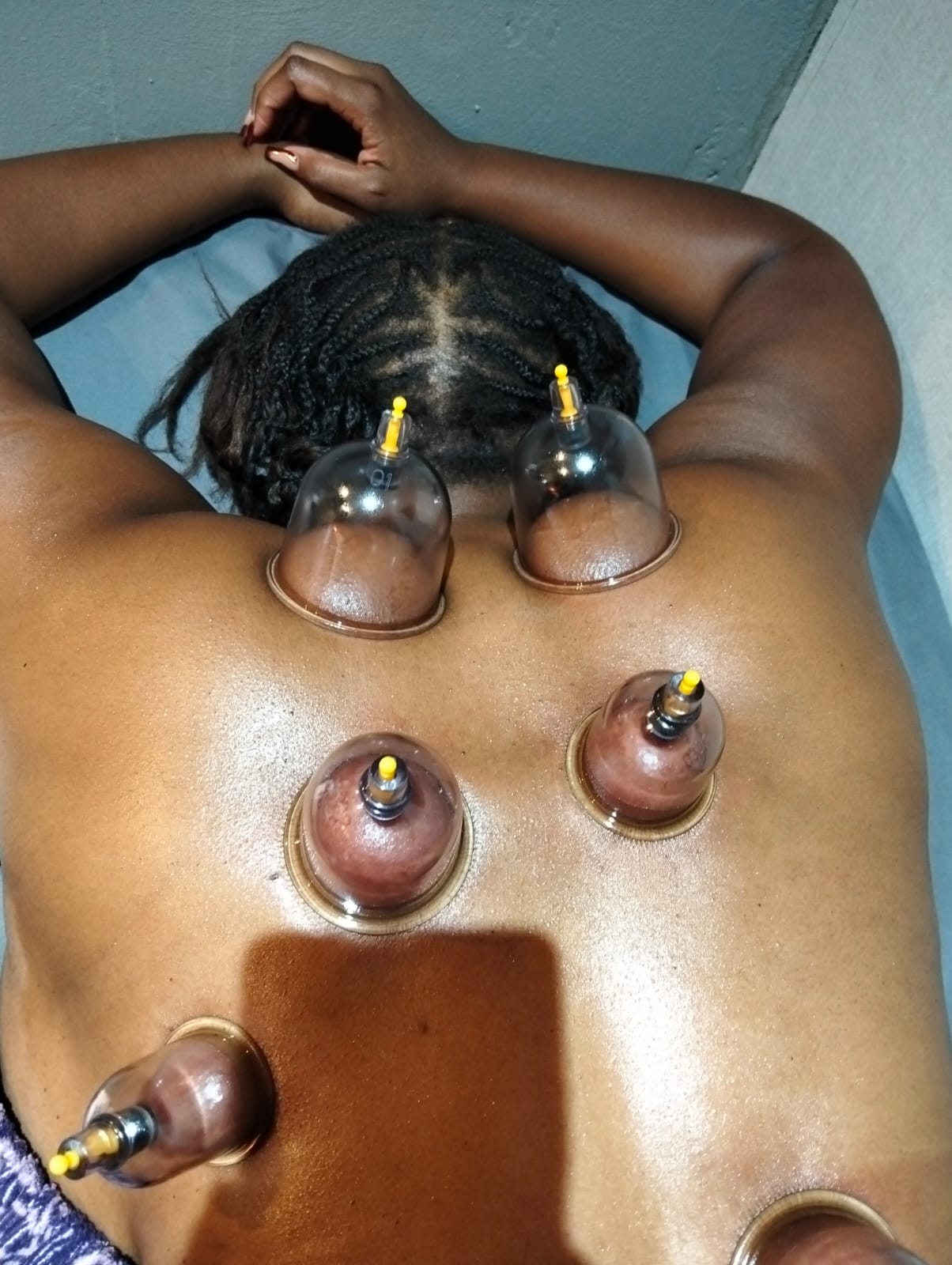 Cupping Therapy